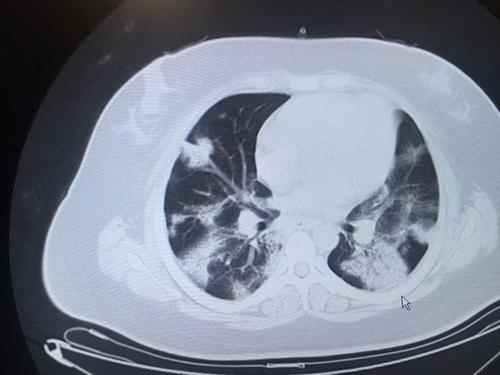 俊豪老师说肺病之新冠肺炎前世今生(影像篇)