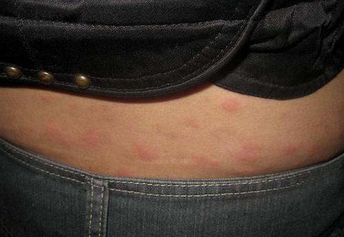 急性荨麻疹如何判断你清楚吗