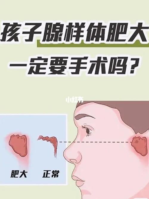 孩子腺样体肥大,一定要手术吗?