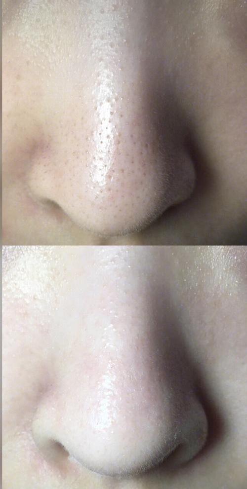 去黑头前后对比