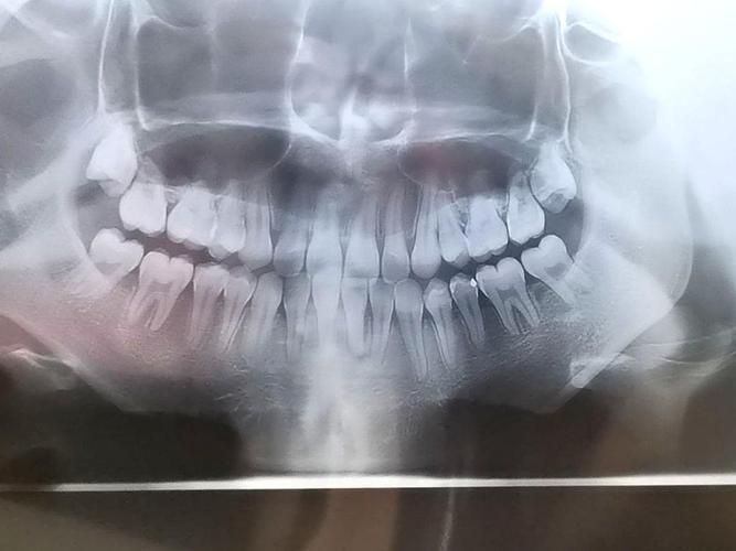 看看我的牙 上排智齿要拔嘛