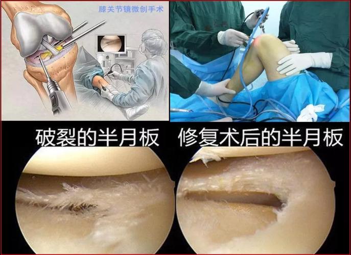 主播薇娅半月板损伤做手术上热搜,这个病我们都要小心
