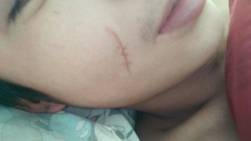 拆线一个月了为什么还是红色的会留疤吗