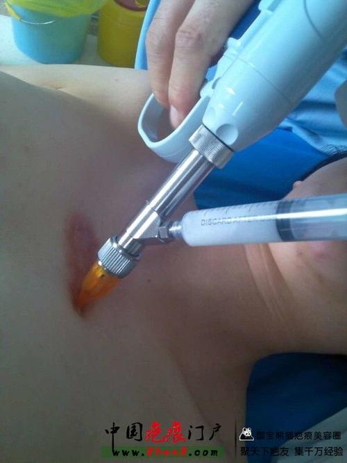 无针注射疤痕——想要爱你不容易