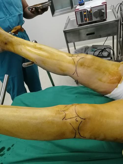 双膝关节半月板损伤关节镜治疗