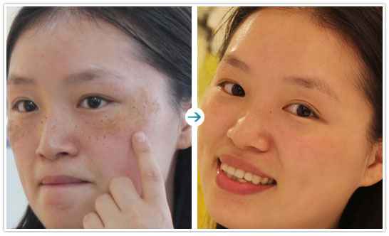 黄褐斑怎么办