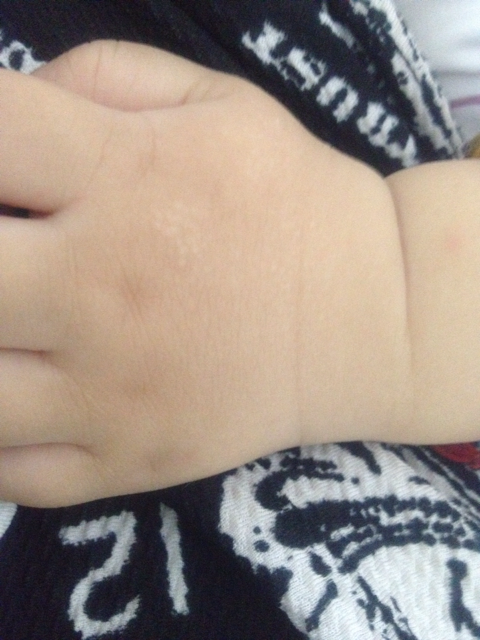 宝宝手背上的白点点是什么东西啊