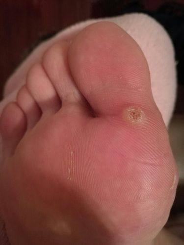 我的脚上这是长鸡眼了吗?有两个月了,碰到会痛,怎么样可以治好呢?