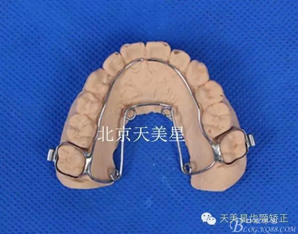 固定式扩弓器在牙弓狭窄,牙列拥挤病例中的应用