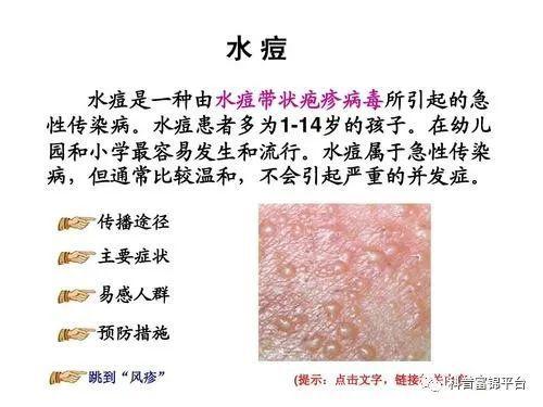 富锦人带状疱疹会传染吗水泡要不要弄破牢记这五点