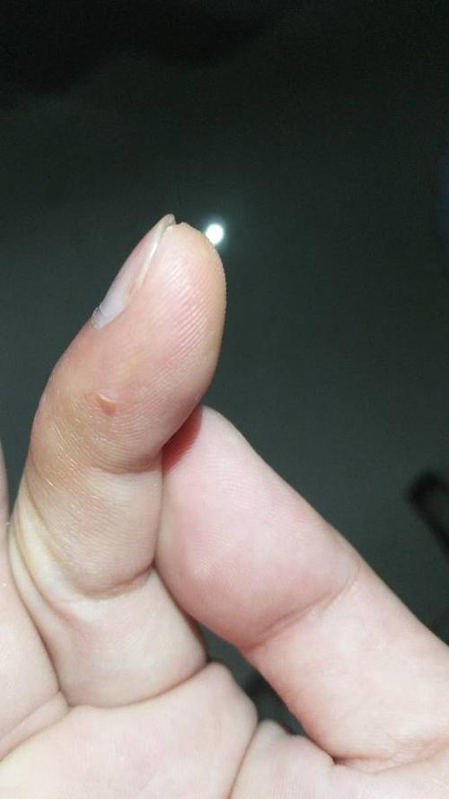 被仓鼠咬了 出血了 我去校医那抹碘伏 人家说不用 直接去打狂犬疫苗