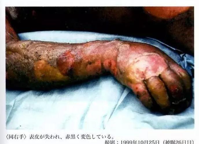 日本东海村核临界事故-治疗核辐射83天的记录