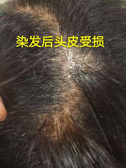 再次染发,再次伤发,再次伤头皮,周而复始恶性循环,白发越来越多,黑发
