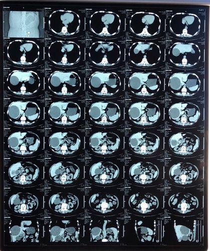 中医院外科为80岁患者成功实施经腹腔镜胆囊切除术 巨大肝囊肿开窗