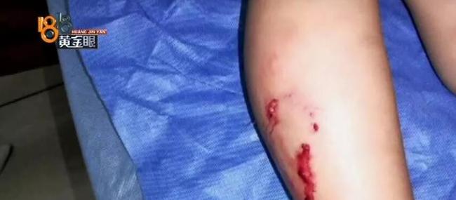 孩子右眼,右腿多处有明显的牙印,已经贯穿皮肤.