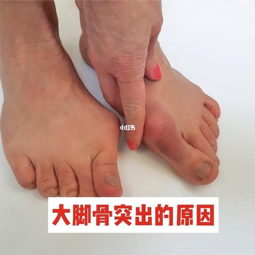 9215大脚趾头旁骨头突出原因?你肯定不知道_鞋子