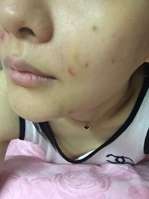 各位帮我看看 我打了玻尿酸填充法令纹后 有一块硬块 有点发炎红肿