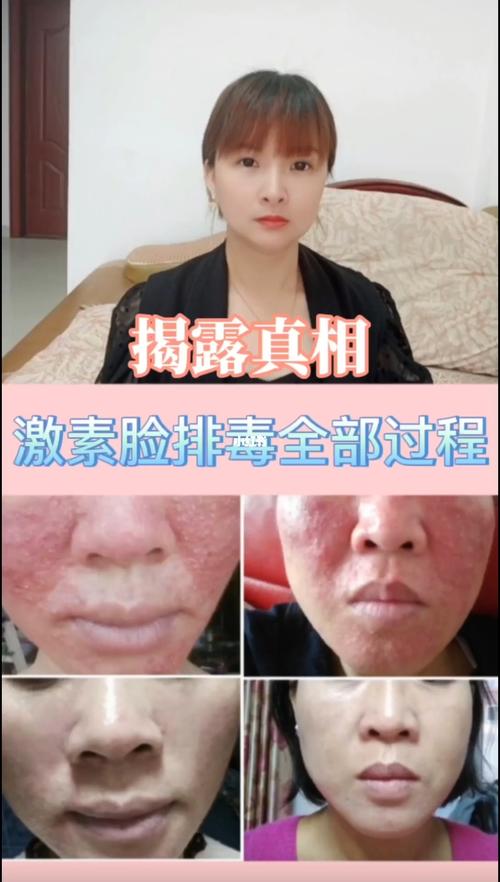 激素脸排毒全部过程!