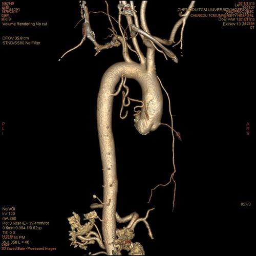 李裁缝先通过患者的胸部cta大概找到患者的支气管动脉开口.