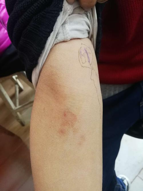 前臂神经纤维瘤