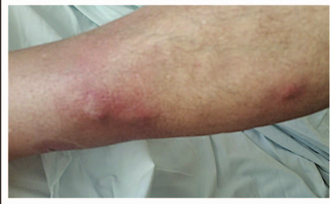 结节坏死性皮肤和软组织感染铜绿假单菌引起皮肤和软组织的坏死是非常