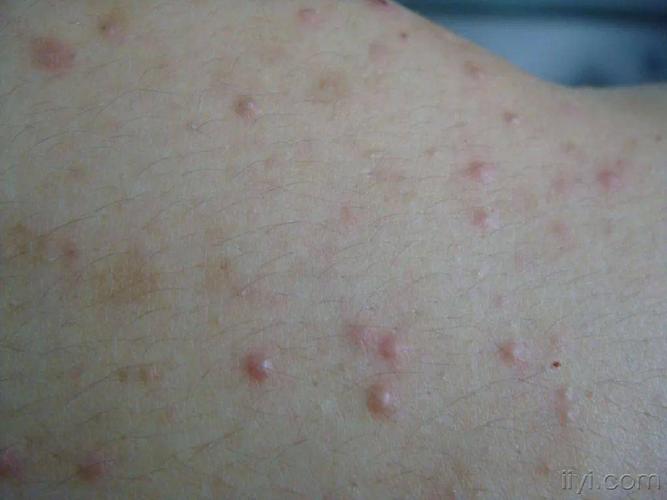 跟青春痘不同的是,毛囊炎结痂后不会留下任何痕迹,当然二者的治疗