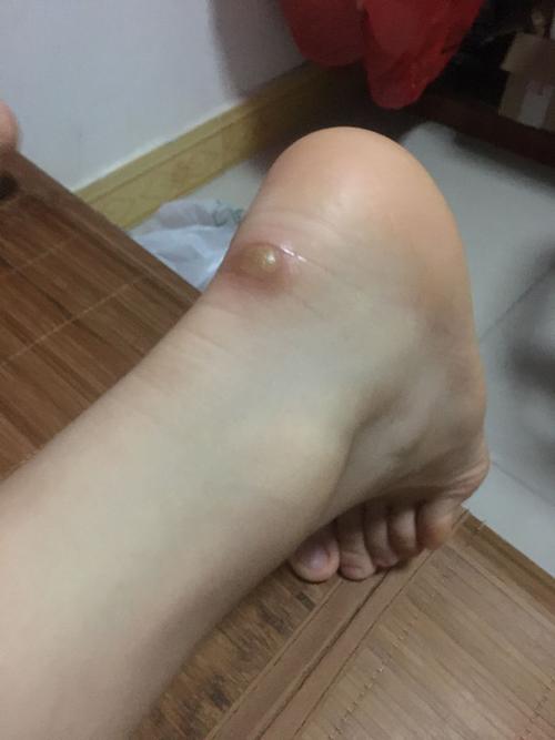 脚跟背后磨破了鼓起的一块要怎么处理