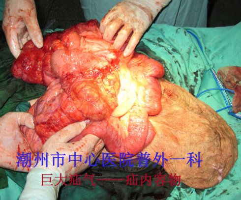 一个巨大疝气病例