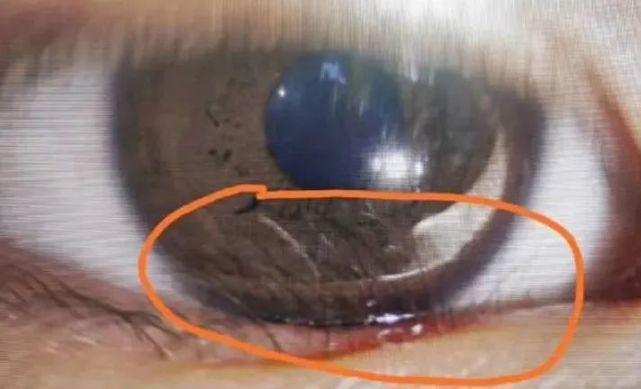 睫毛倒着长眼睛总是睁不开这些症状老人小孩都要注意