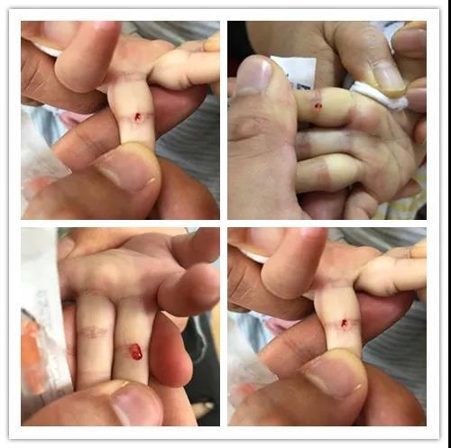 疳积|小儿|发育_新浪