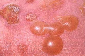 天疱疮的临床表现