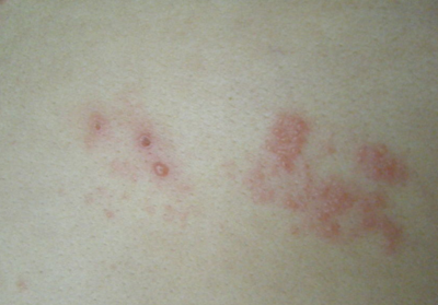 年过五十出疹子 警惕癌症来袭!