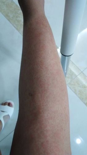 荨麻疹?过敏?_百度知道