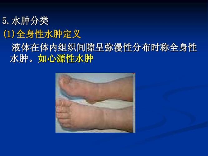 诊断学:水肿新:44ppt