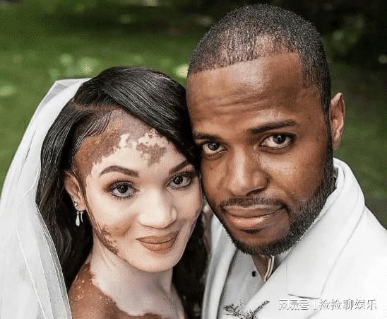 这是黑人得了白化病还是白人得了黑化病