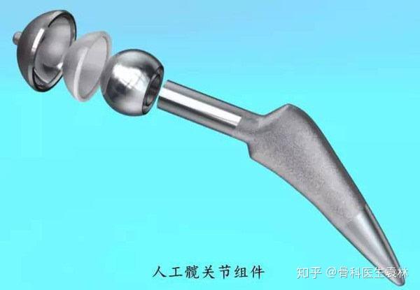 人工髋关节什么样子的?人工髋关节的使用寿命有多长?