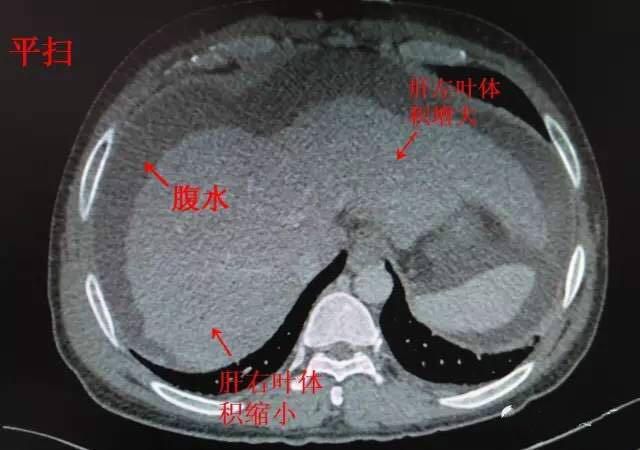 医生文章 正文 肝硬化主要ct表现: 1.
