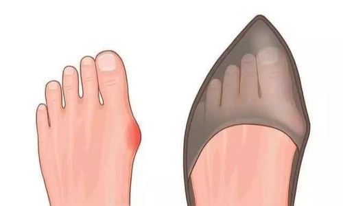 给拇外翻(大脚骨,脚骨拐)朋友的小建议_鞋子_按摩_泡脚_脚部_运动