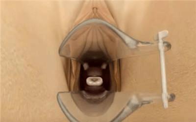 产后不想再要孩子是上环还是买避孕套看完上环全过程你就知道了