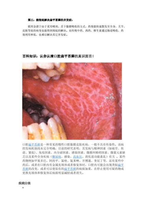 医学前沿联邦金溃宁让人类告别口腔扁平苔藓!doc