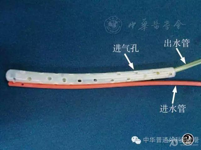 黎氏引流管在腹腔镜胃癌根治术后吻合口瘘中的应用