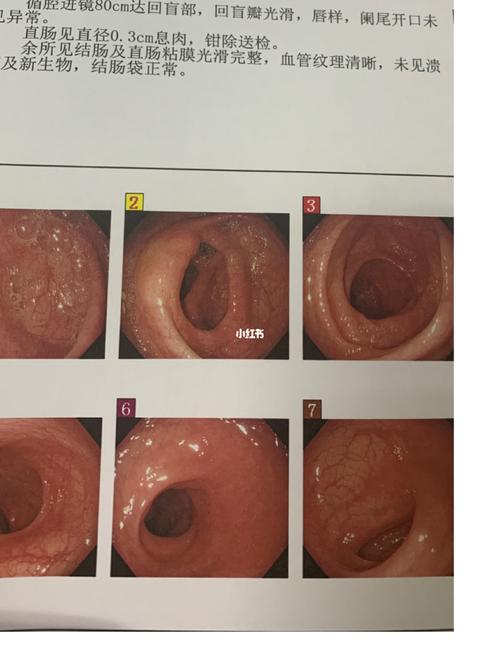 肠镜_肠道_核酸_幽门螺旋杆菌_肠胃_菊花_医疗健康