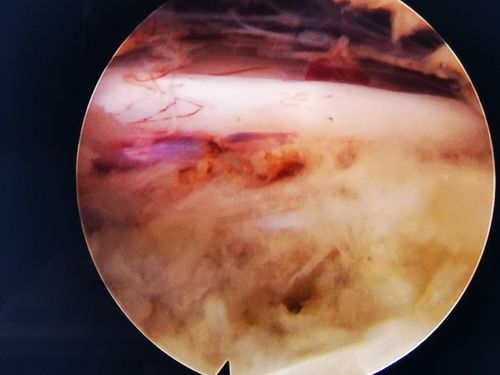 甘肃省中医院邓强主任团队完成第三例镜下纤维环缝合术