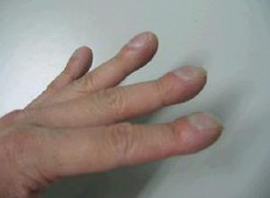 杵状指(趾)怎么回事?