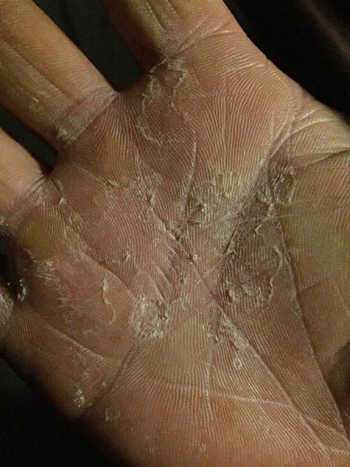 一到冬天手就干燥脱皮严重,很滑没水分