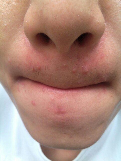 大家,看看,我的嘴巴周围张痘痘,将近,快两年了,有什么好办法去除吗?