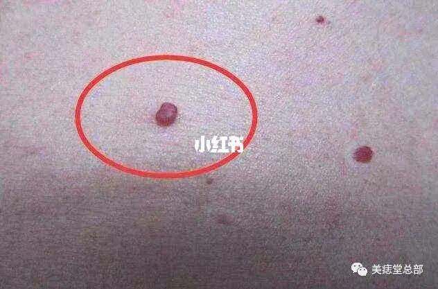 血管痣 皮肤上突然出现这种小红点,_青春期_血管瘤_棉签_孕妇_新陈