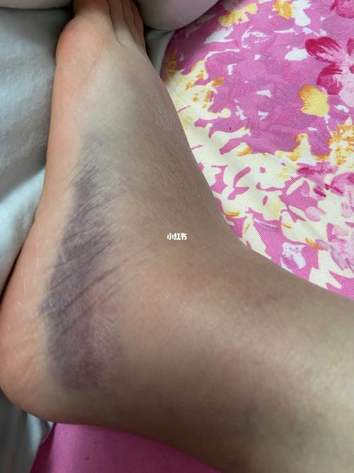 记一下脚拐伤的日子,淤青一天比一天重_医疗健康_医疗