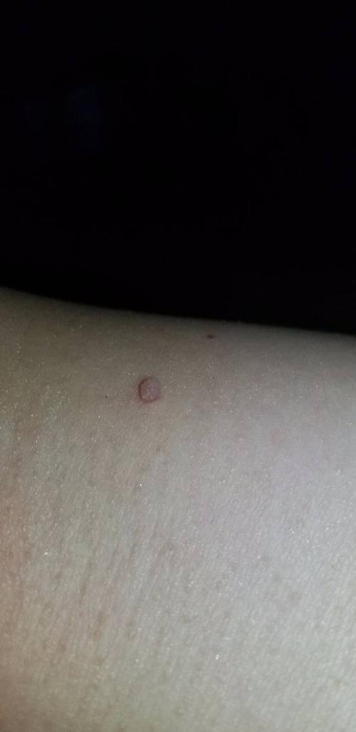 肩膀上长了个小肉疙瘩,不痛不痒有医生或者懂得朋友给看下是什么吗?