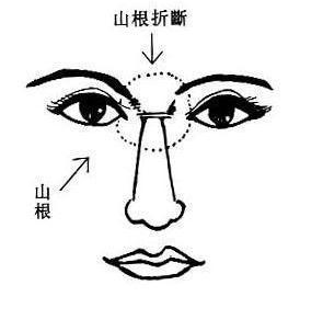 山根断山根是什么